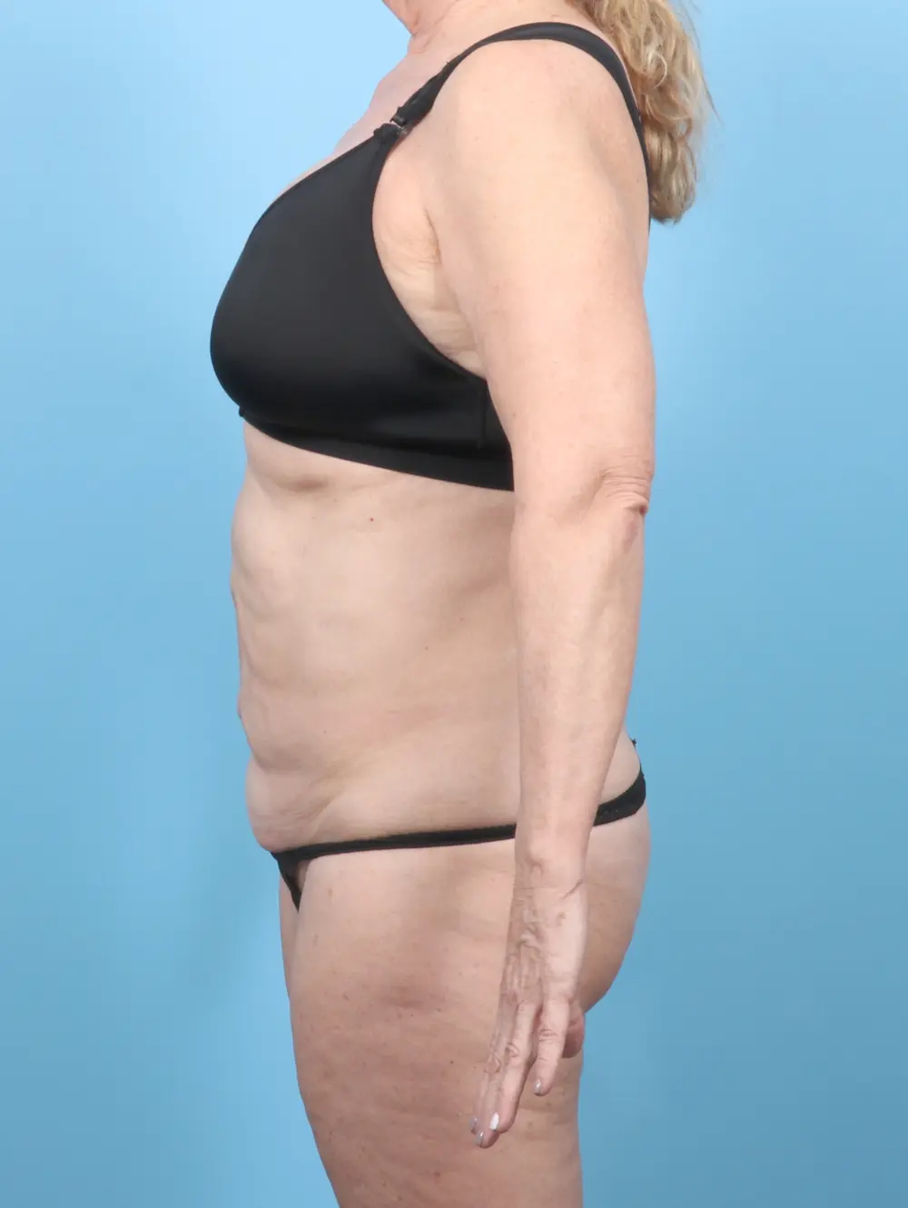 Tummy Tuck Patient Photo - Case 55541 - before view-2