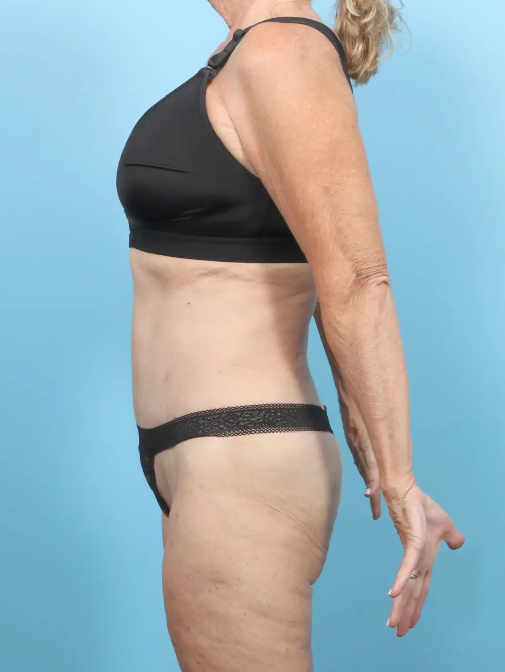 Tummy Tuck Patient Photo - Case 55541 - after view-2