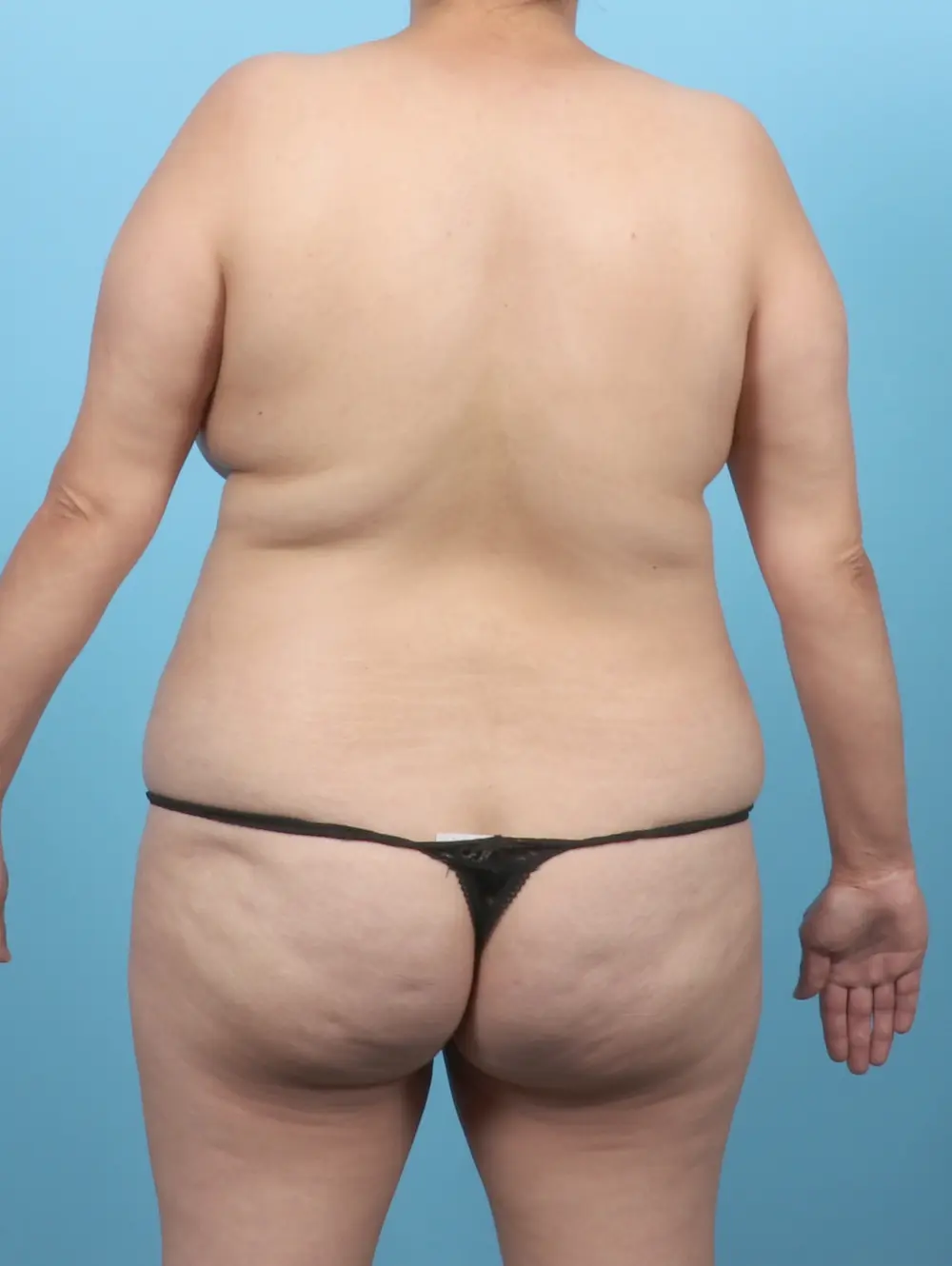 Breast Lift/Reduction with Implants Patient Photo - Case 55573 - before view-3