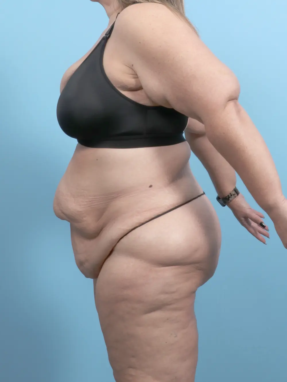 After Weight Loss Patient Photo - Case 55697 - before view-2