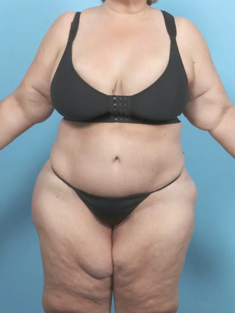 After Weight Loss - Case 55697 - After