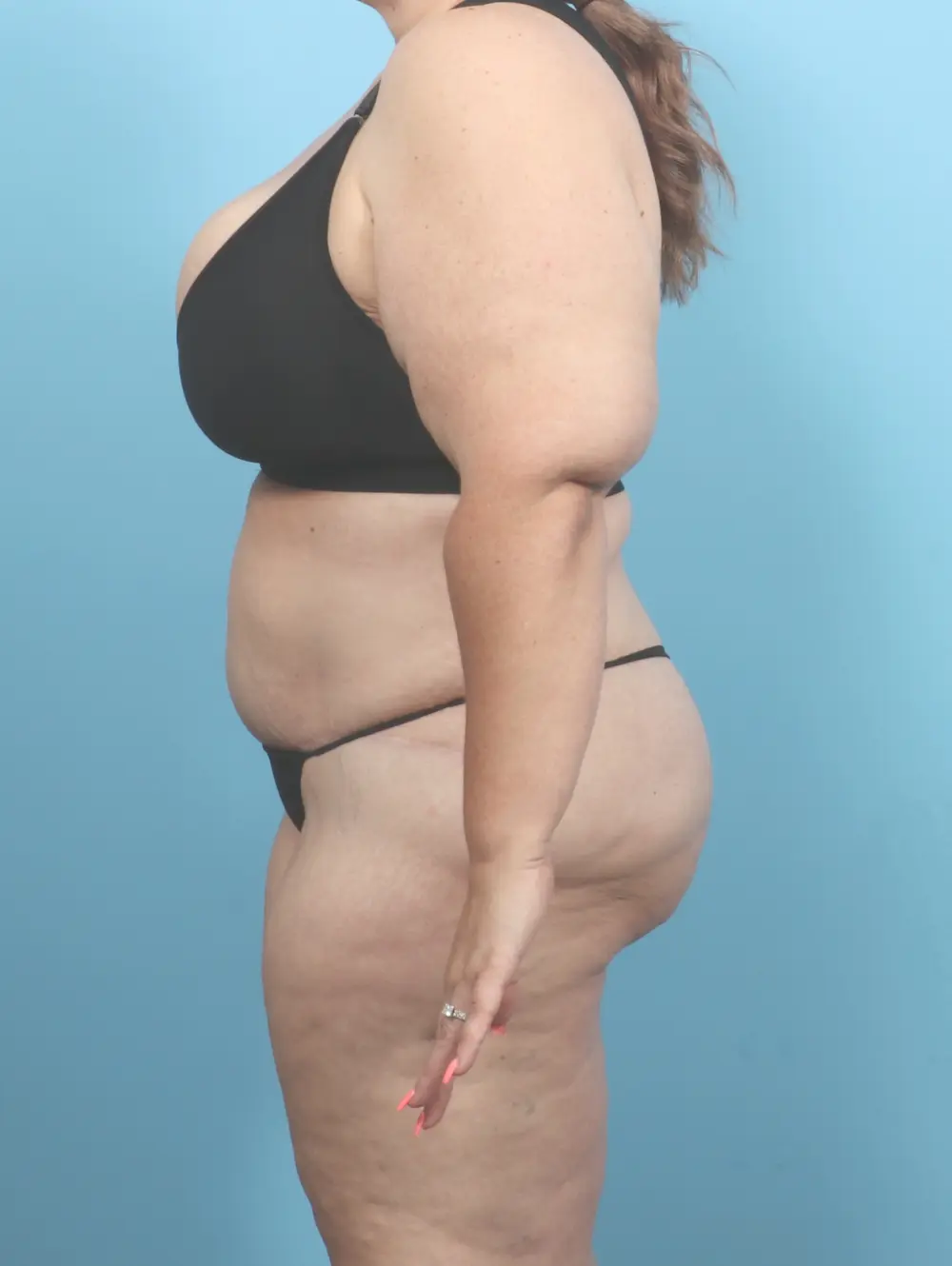 After Weight Loss Patient Photo - Case 55697 - after view-2