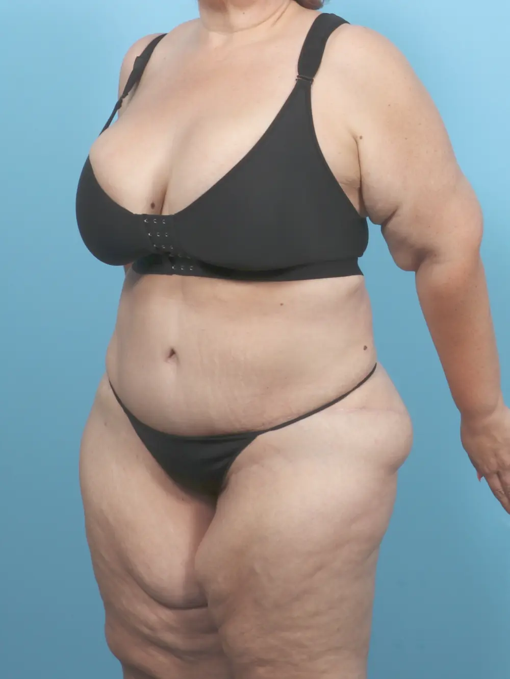 After Weight Loss Patient Photo - Case 55697 - after view-1