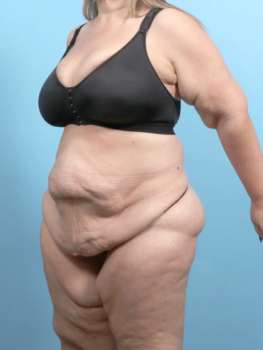 After Weight Loss Patient Photo - Case 55697 - before view-1