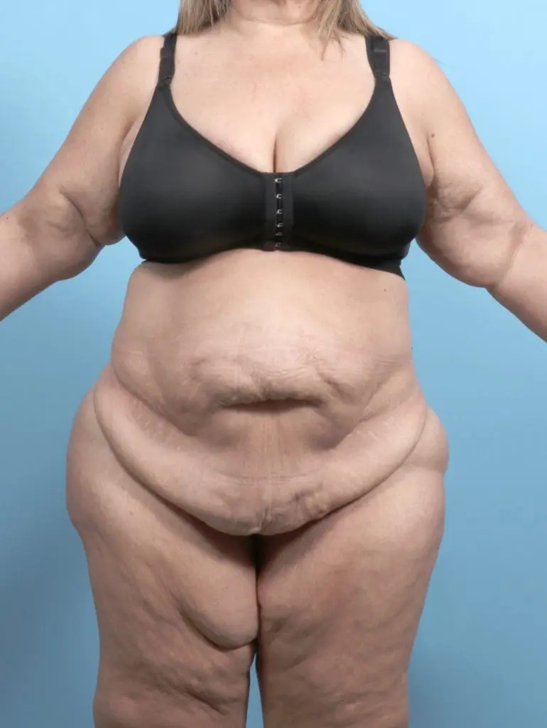 After Weight Loss - Case 55697 - Before