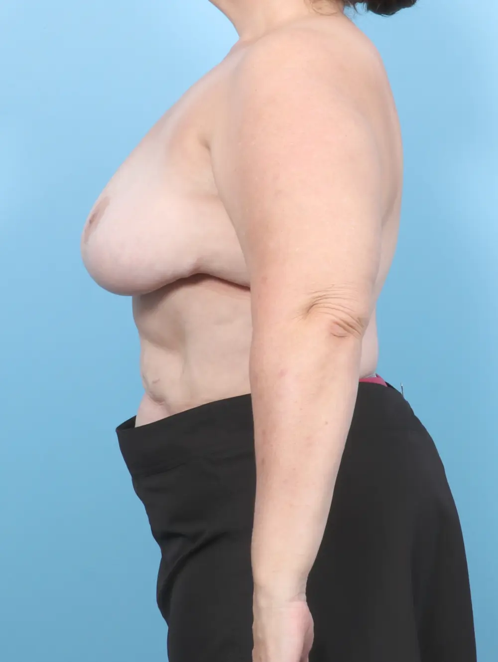 Breast Implant Removal Patient Photo - Case 55748 - after view-2