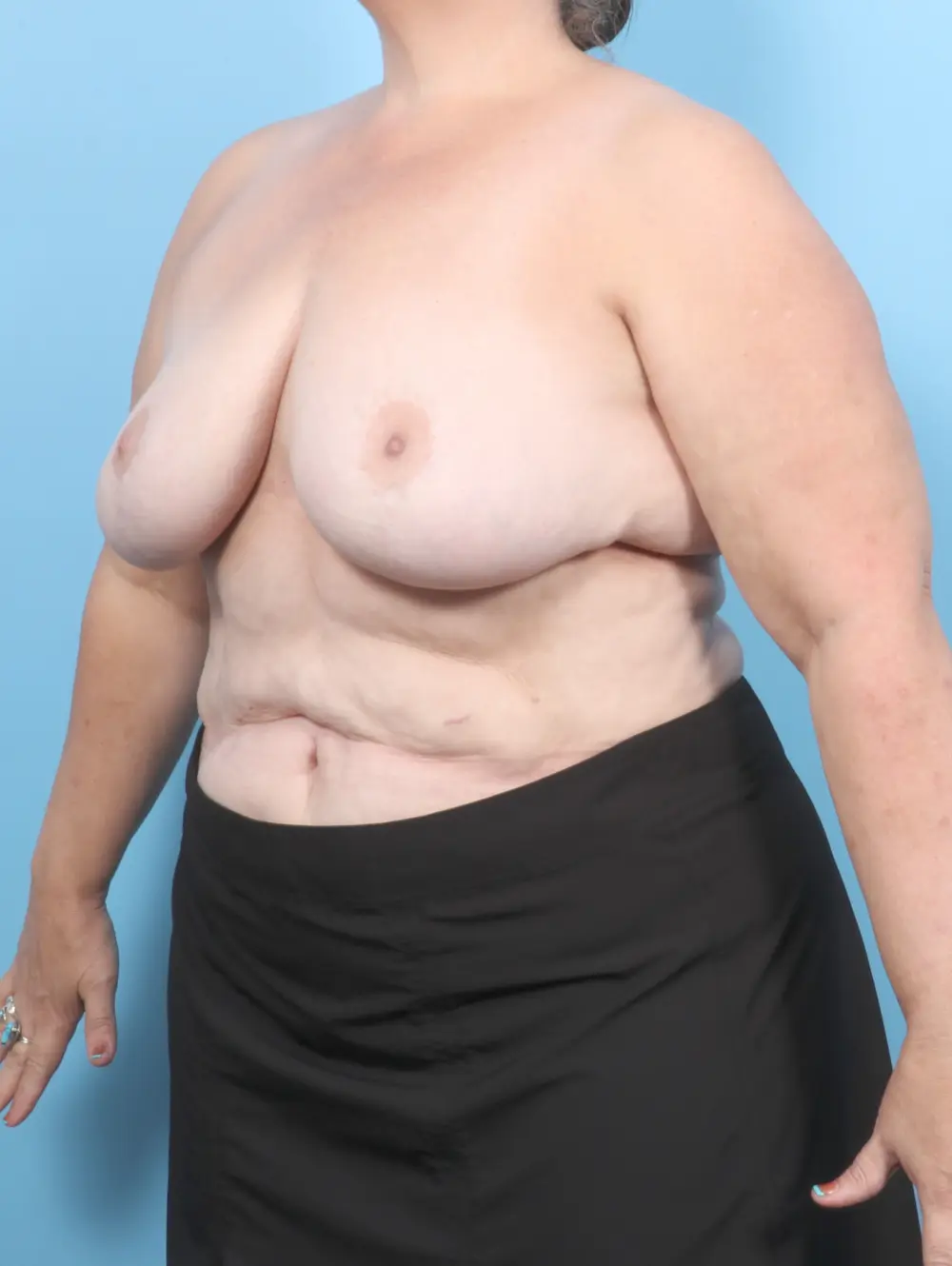 Breast Implant Removal Patient Photo - Case 55748 - after view-1