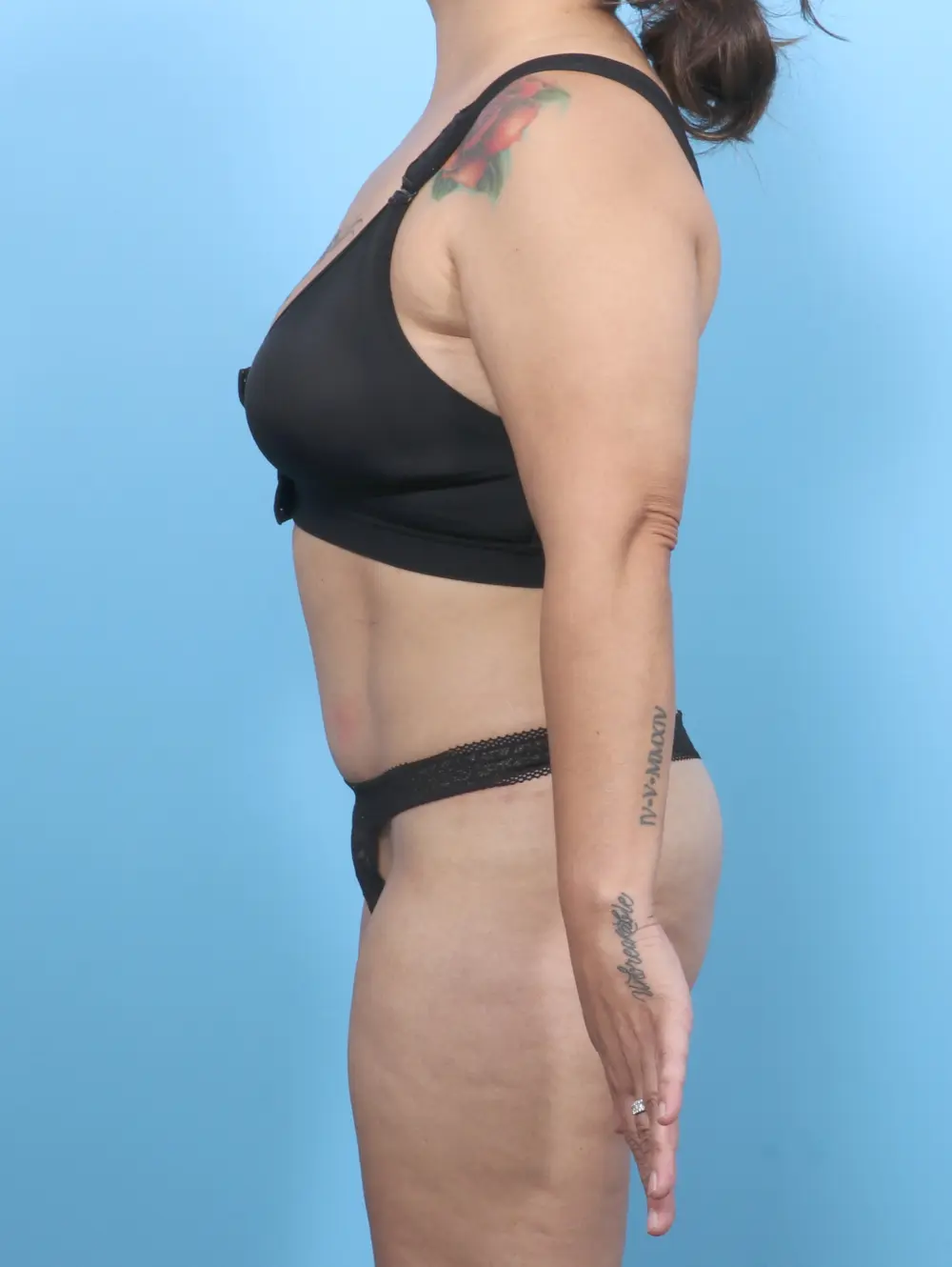 Tummy Tuck Patient Photo - Case 55793 - after view-2
