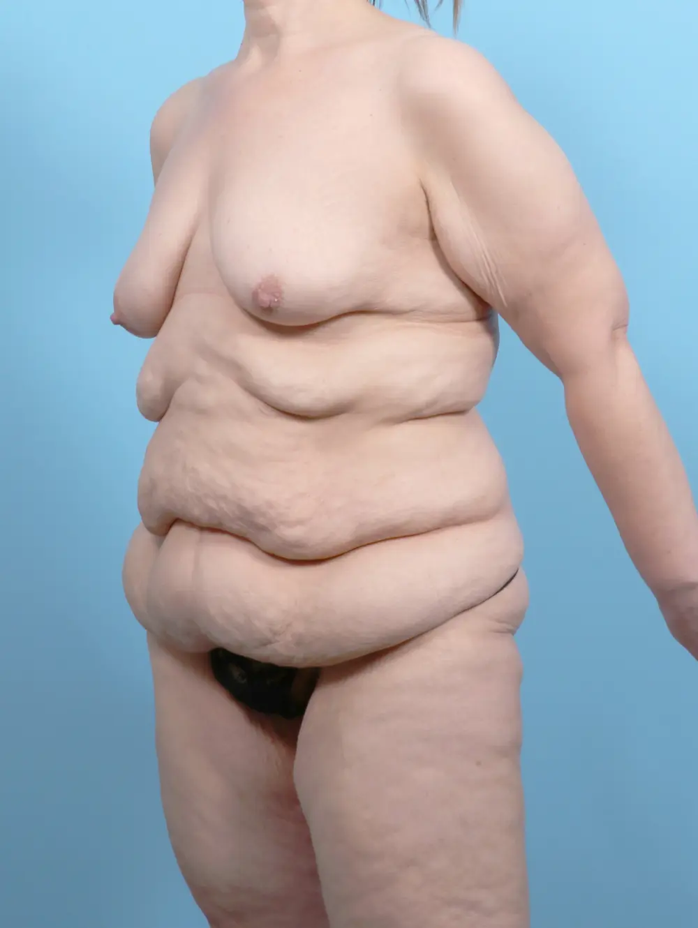 After Weight Loss Patient Photo - Case 55817 - before view-1