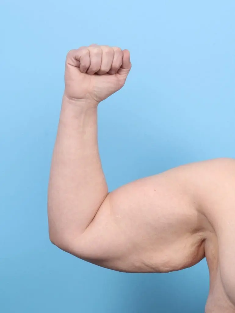 After Weight Loss - Case 55835 - Before