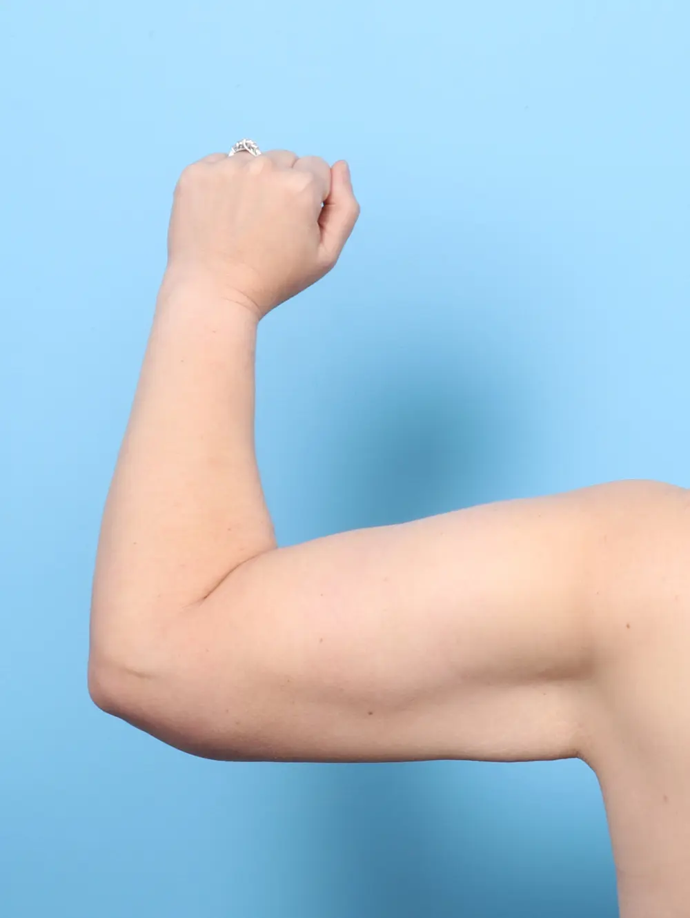 After Weight Loss Patient Photo - Case 55835 - after view-1