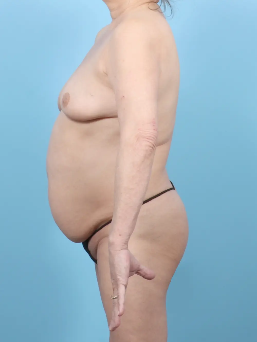 Fat Transfer Patient Photo - Case 55841 - before view-2