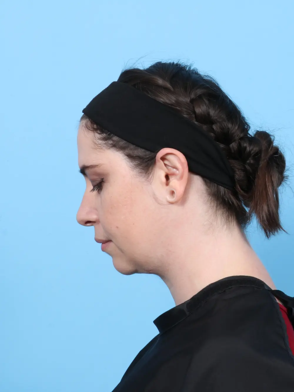 Anterior Neck Lift Patient Photo - Case 55877 - after view-1