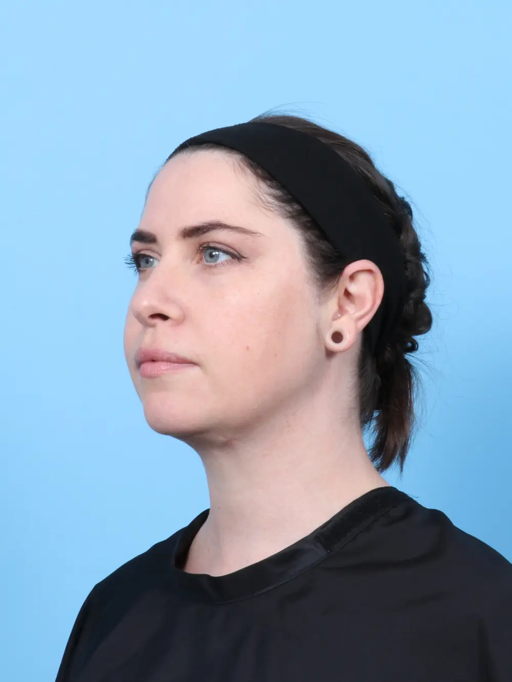 Anterior Neck Lift Patient Photo - Case 55877 - after view-2
