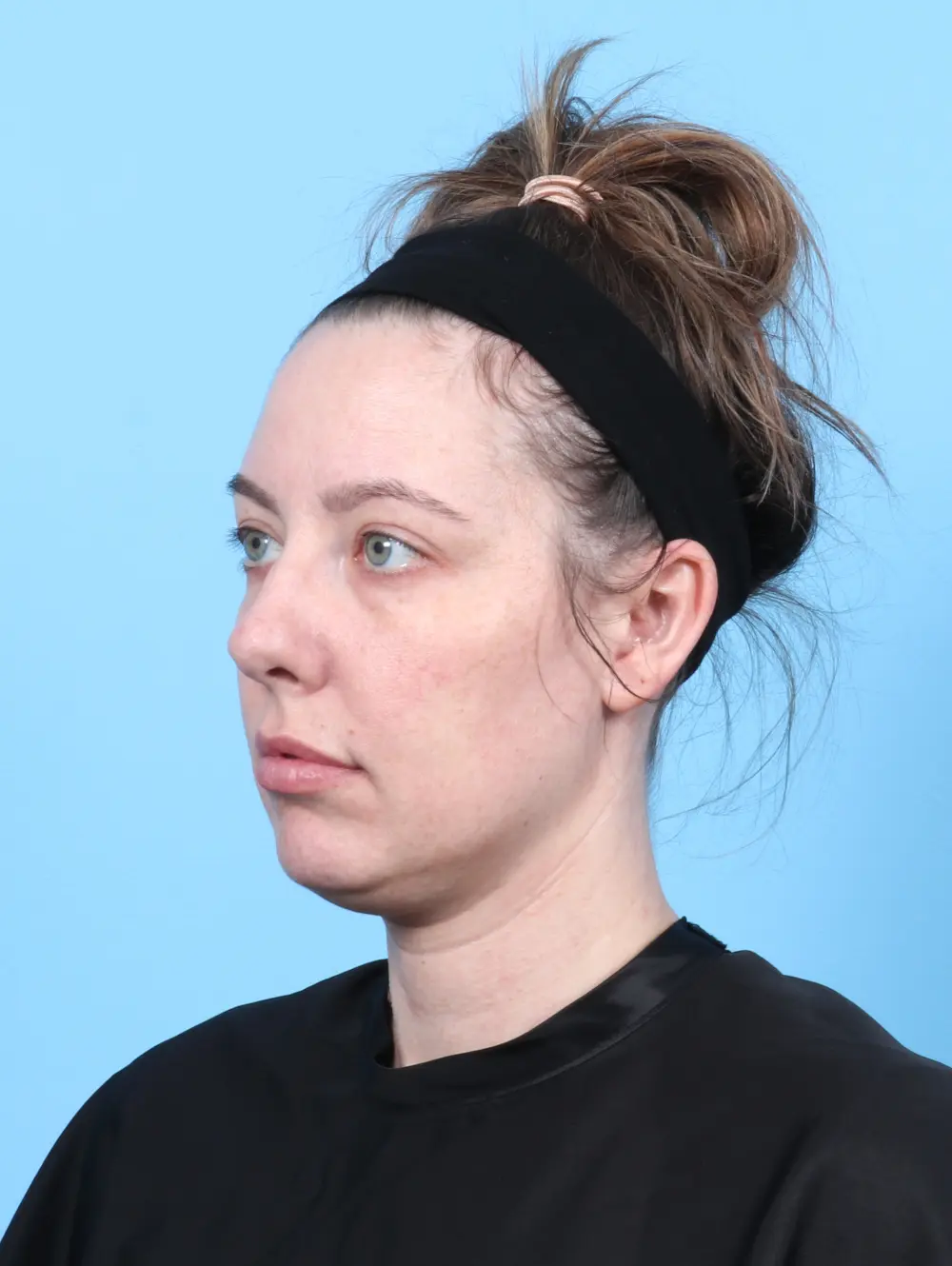 Rhinoplasty Patient Photo - Case 55887 - before view-1
