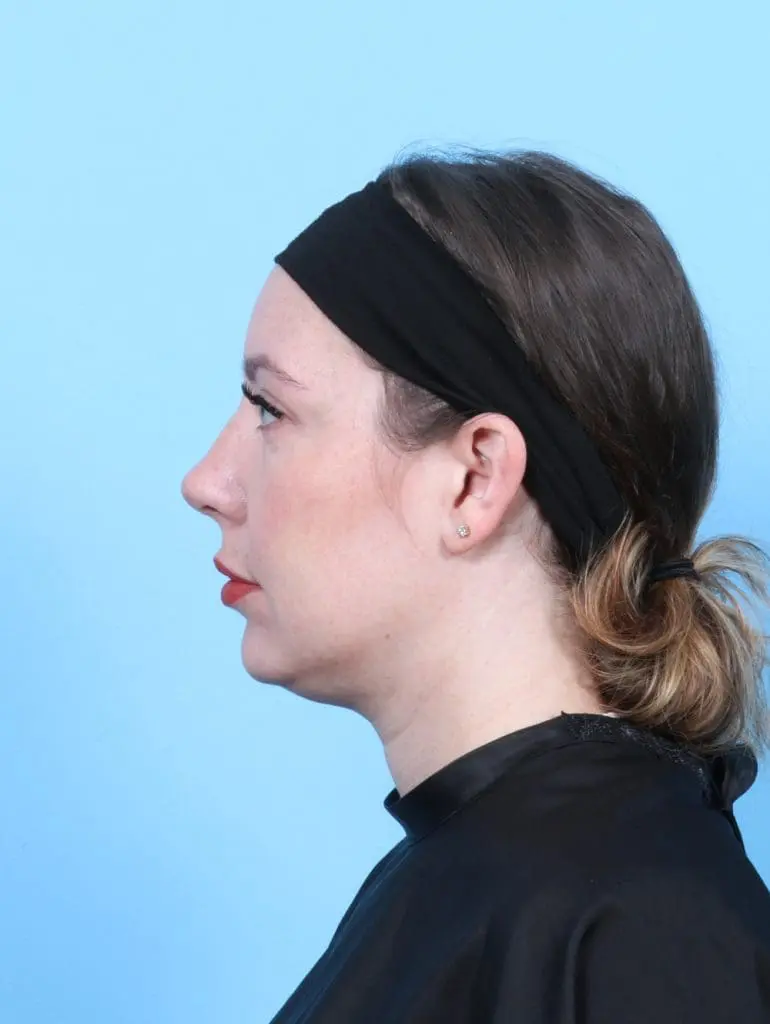 Rhinoplasty - Case 55887 - After