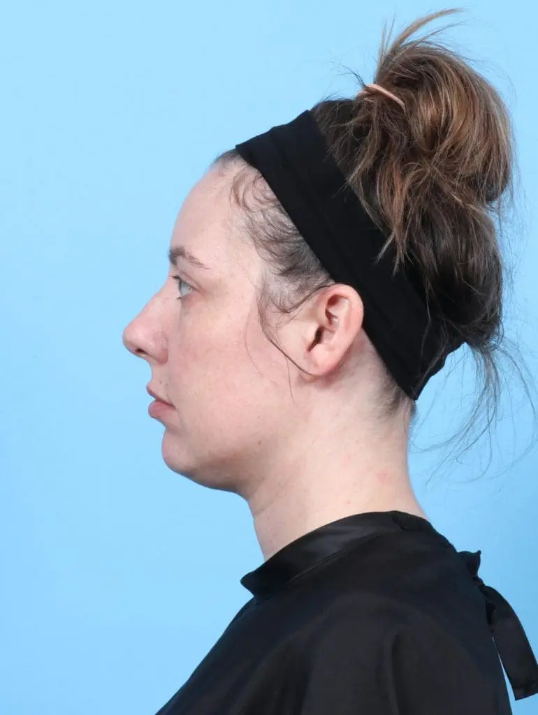 Rhinoplasty - Case 55887 - Before