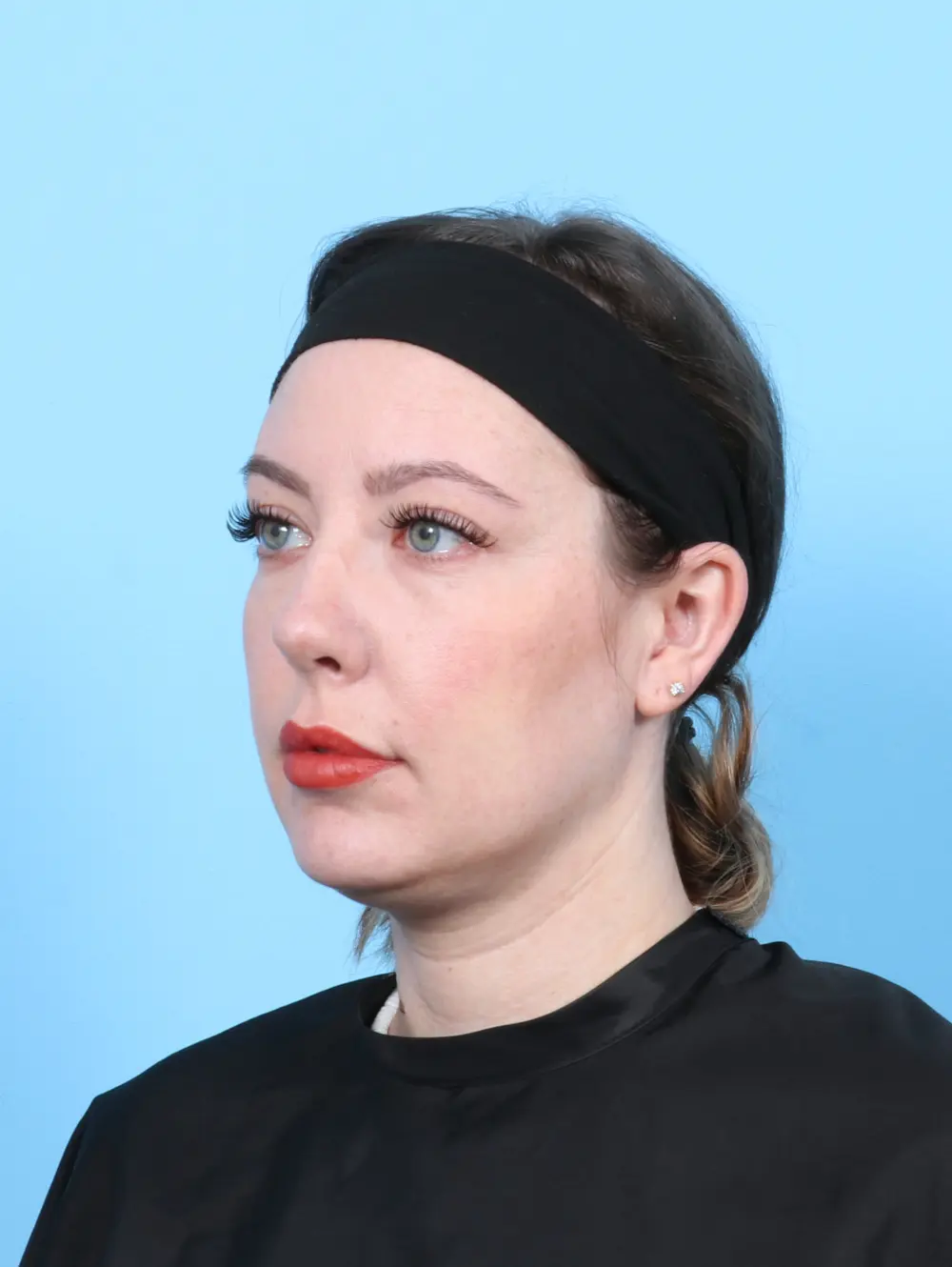 Rhinoplasty Patient Photo - Case 55887 - after view-1