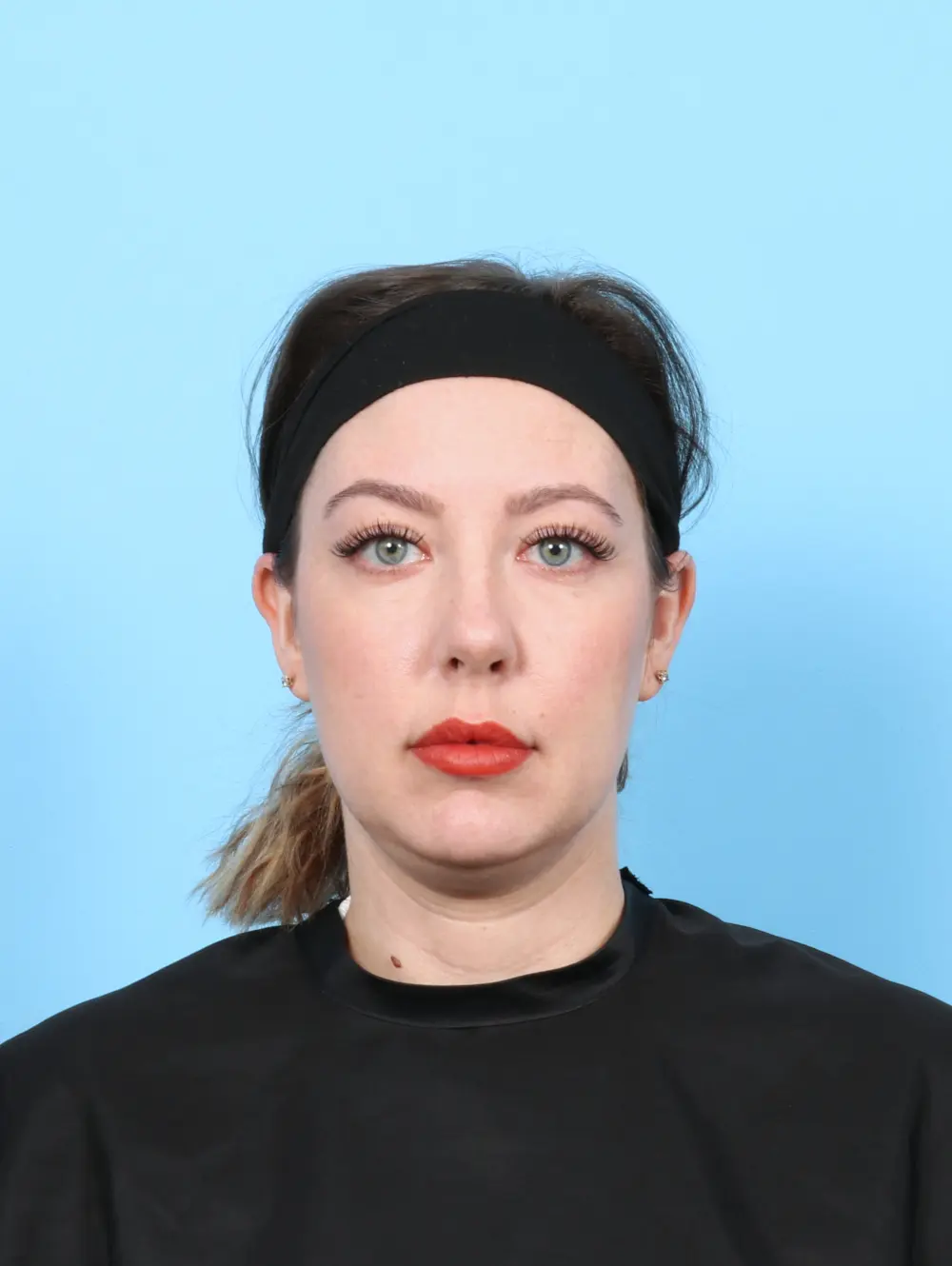 Rhinoplasty Patient Photo - Case 55887 - after view-2