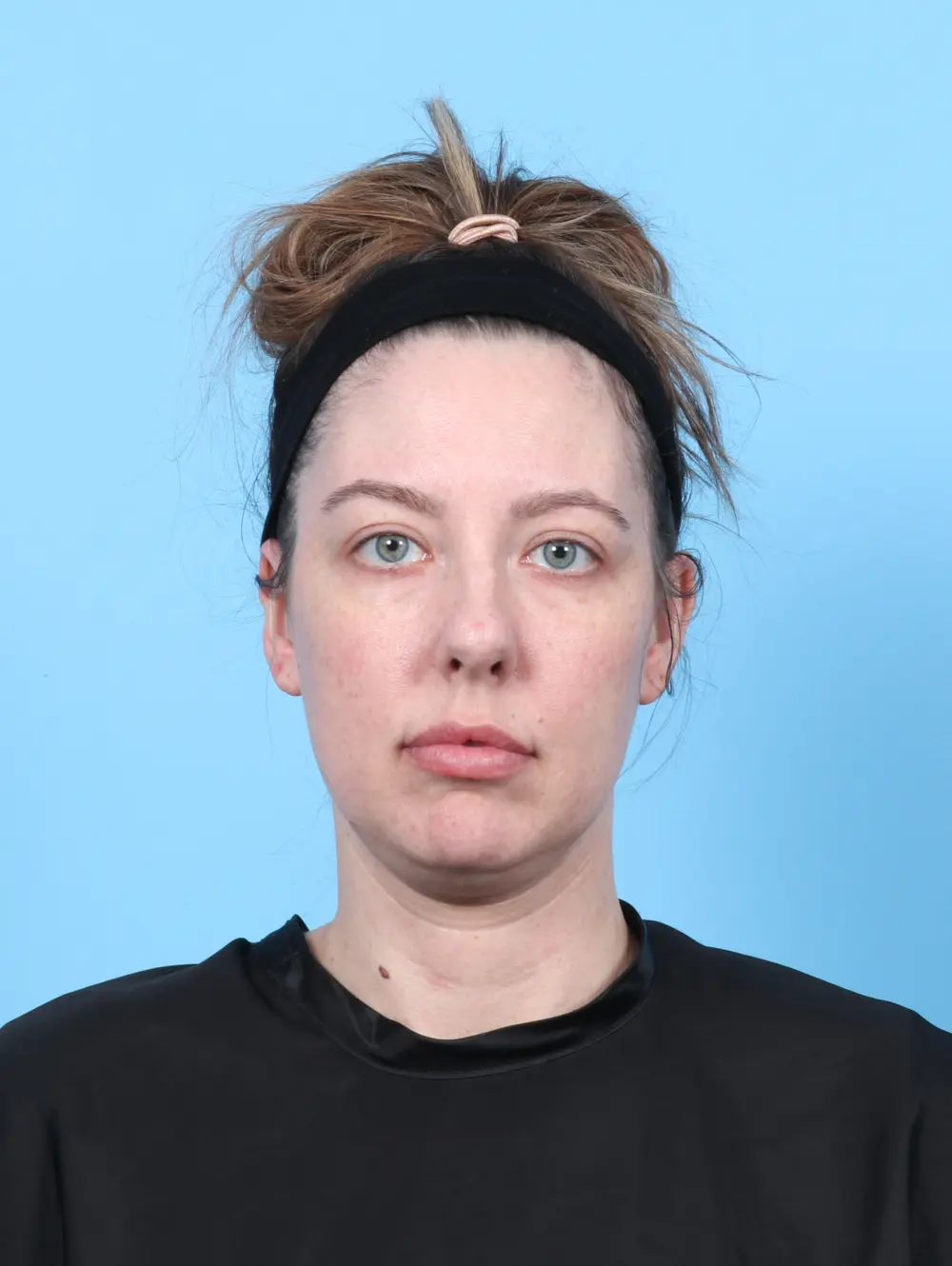 Rhinoplasty Patient Photo - Case 55887 - before view-2