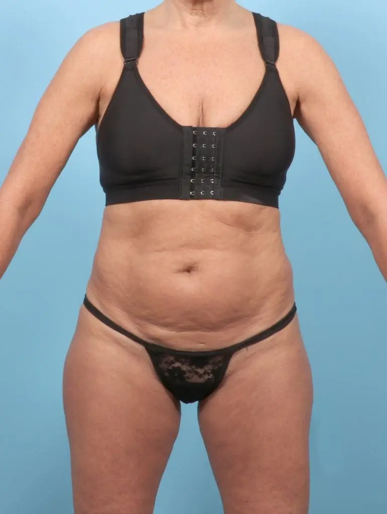 Tummy Tuck - Case 55896 - Before