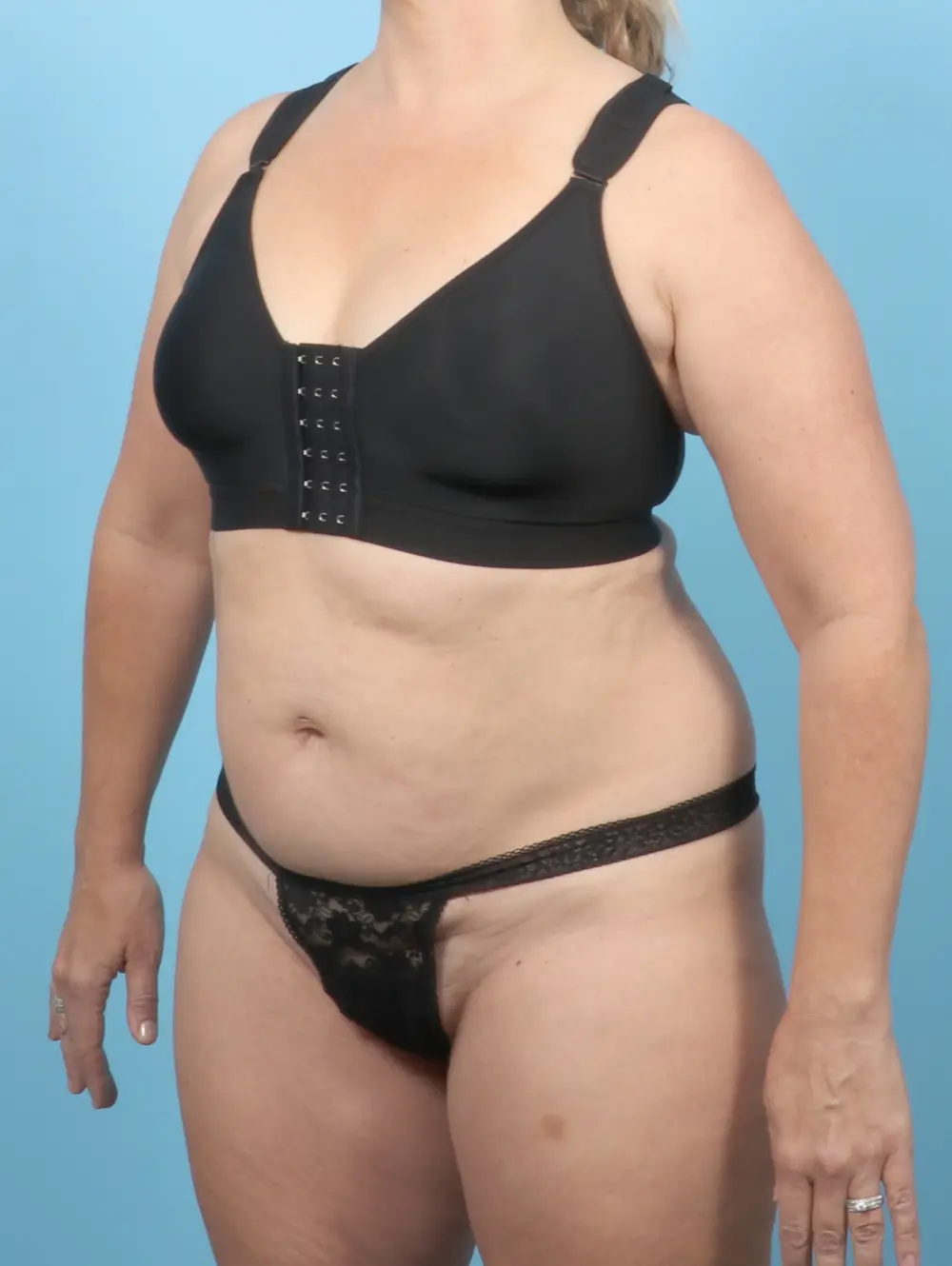 Tummy Tuck Patient Photo - Case 55912 - before view-1