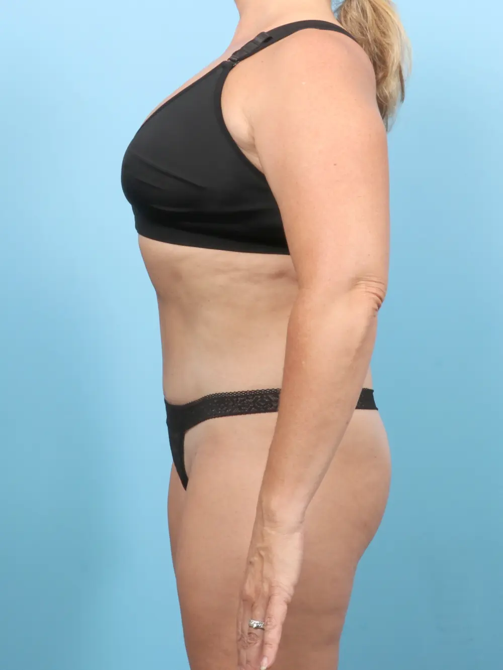 Tummy Tuck Patient Photo - Case 55912 - after view-2
