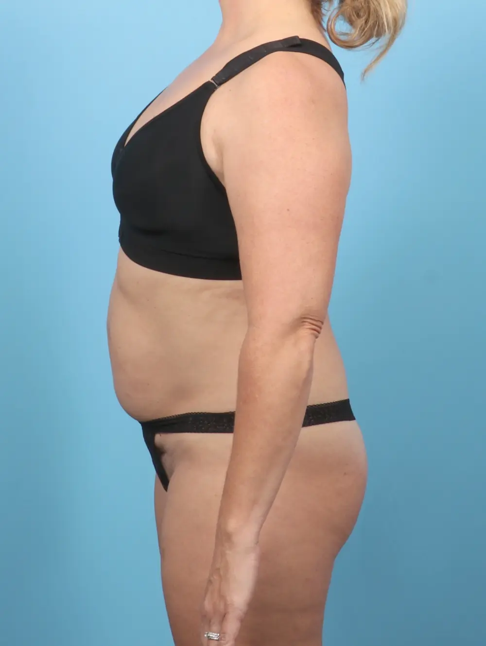 Tummy Tuck Patient Photo - Case 55912 - before view-2