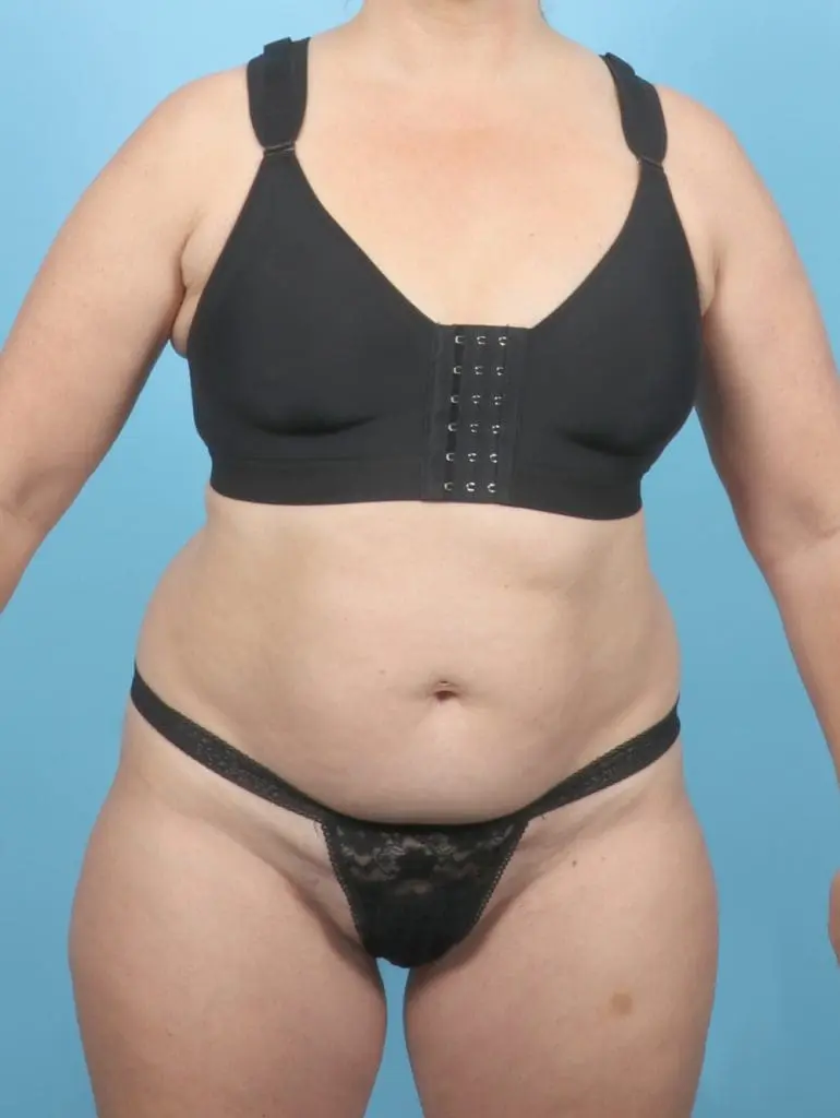 Tummy Tuck - Case 55912 - Before