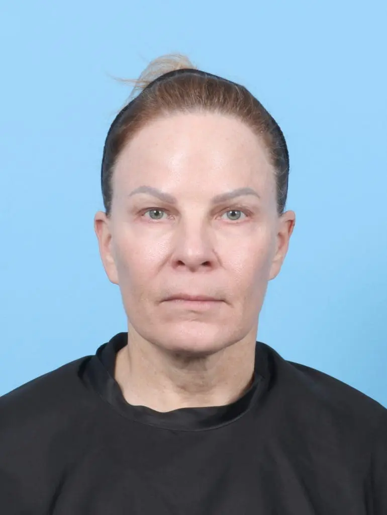 Eyelid Surgery - Case 55920 - Before