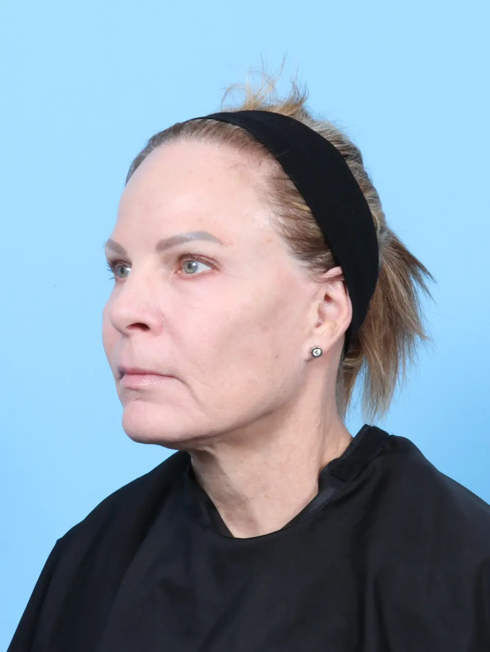 Eyelid Surgery Patient Photo - Case 55920 - after view-1
