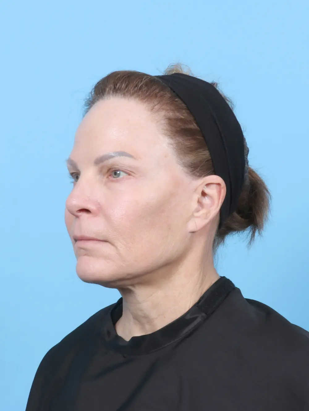 Eyelid Surgery Patient Photo - Case 55920 - before view-1