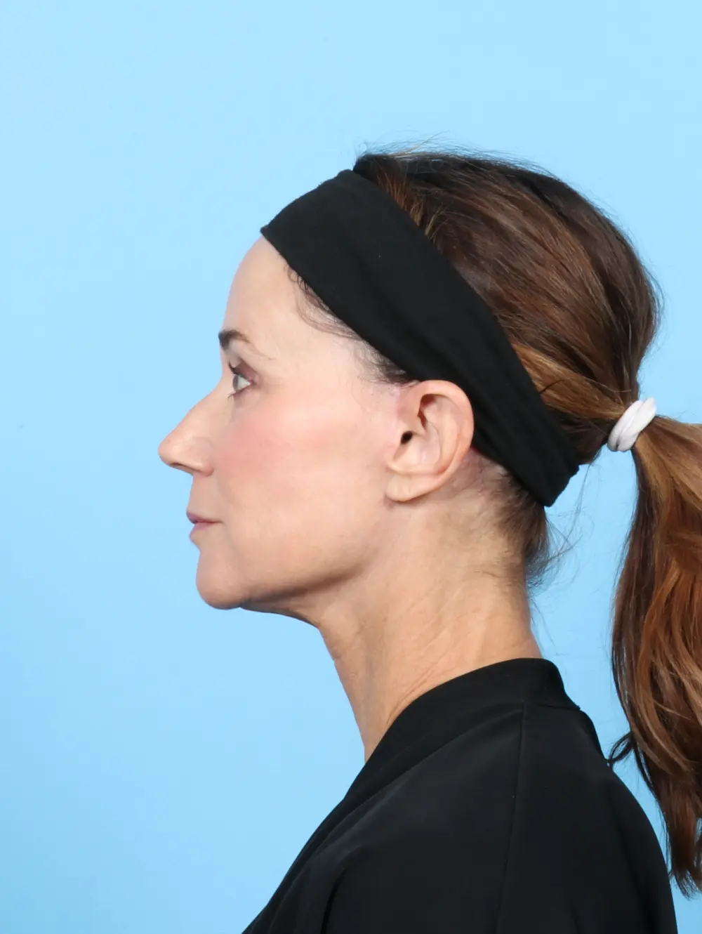 Eyelid Surgery Patient Photo - Case 55928 - after view-2