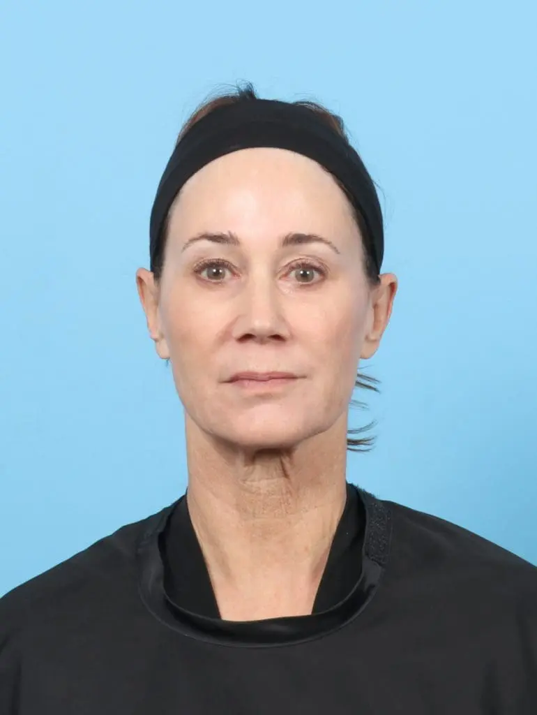 Eyelid Surgery - Case 55928 - Before