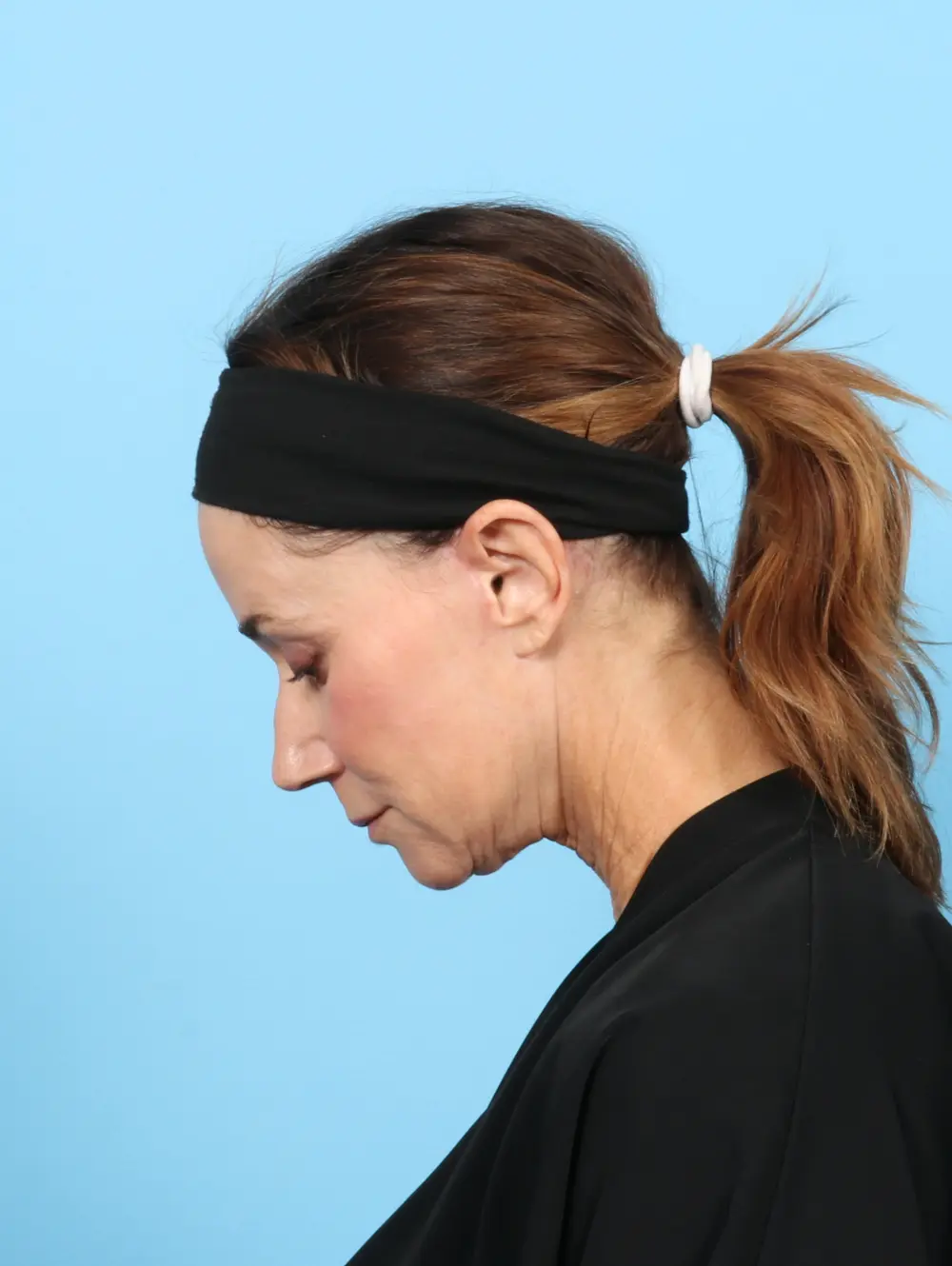 Eyelid Surgery Patient Photo - Case 55928 - after view-3