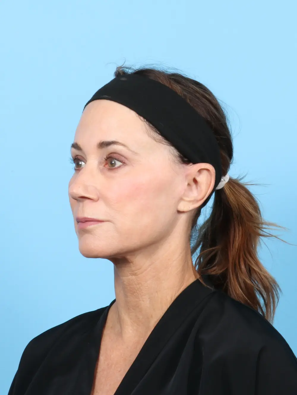 Eyelid Surgery Patient Photo - Case 55928 - after view-1