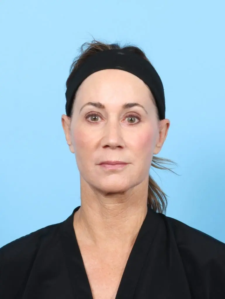 Eyelid Surgery - Case 55928 - After