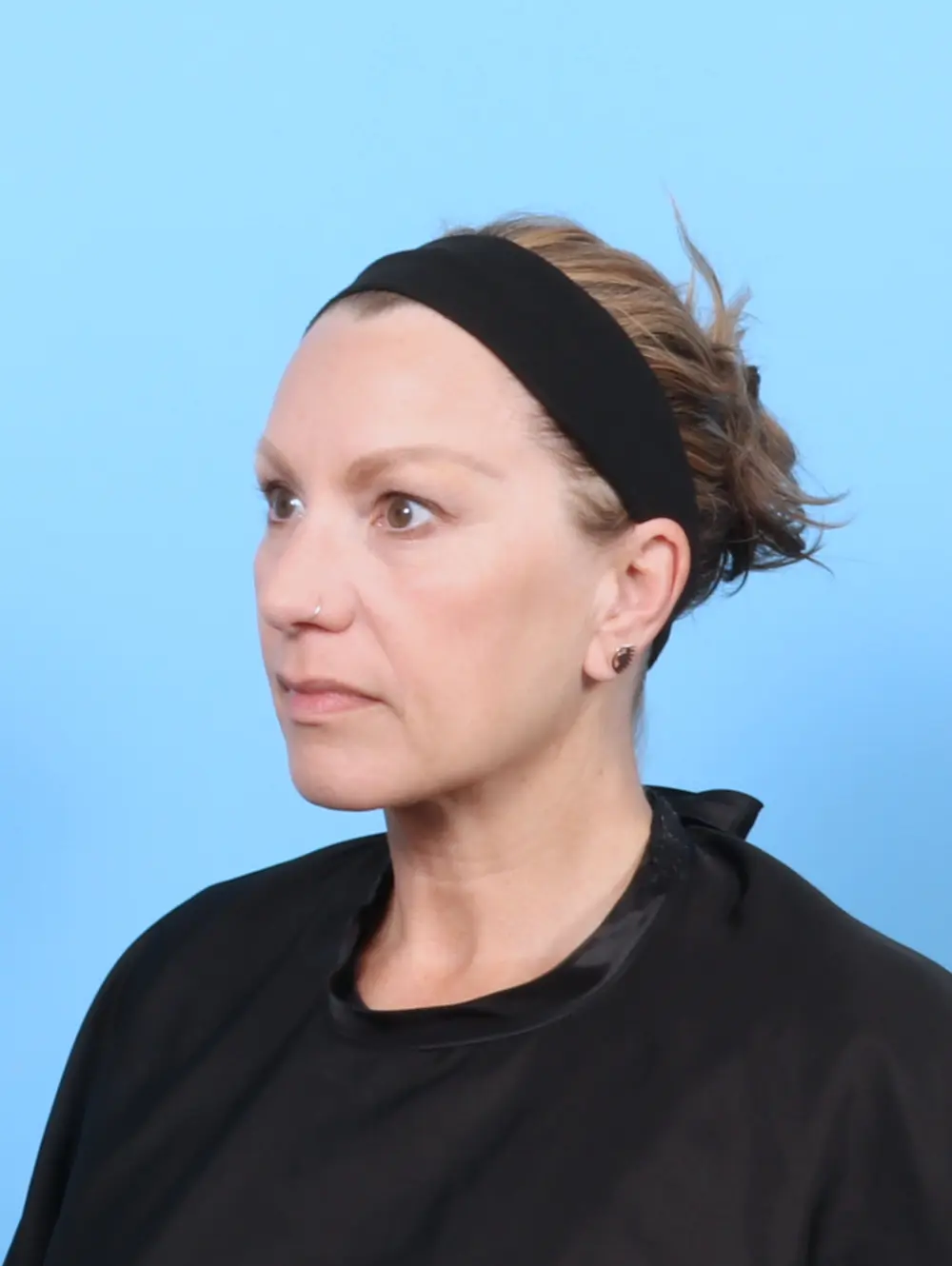 Eyelid Surgery Patient Photo - Case 55971 - before view-1