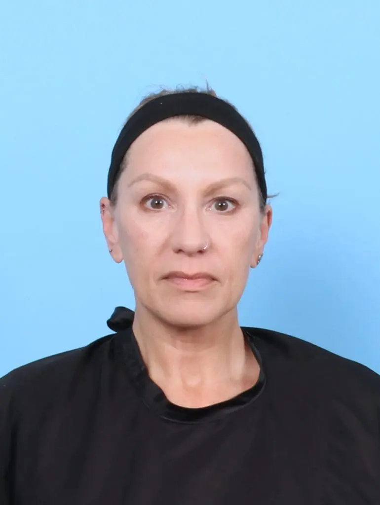 Eyelid Surgery - Case 55971 - Before