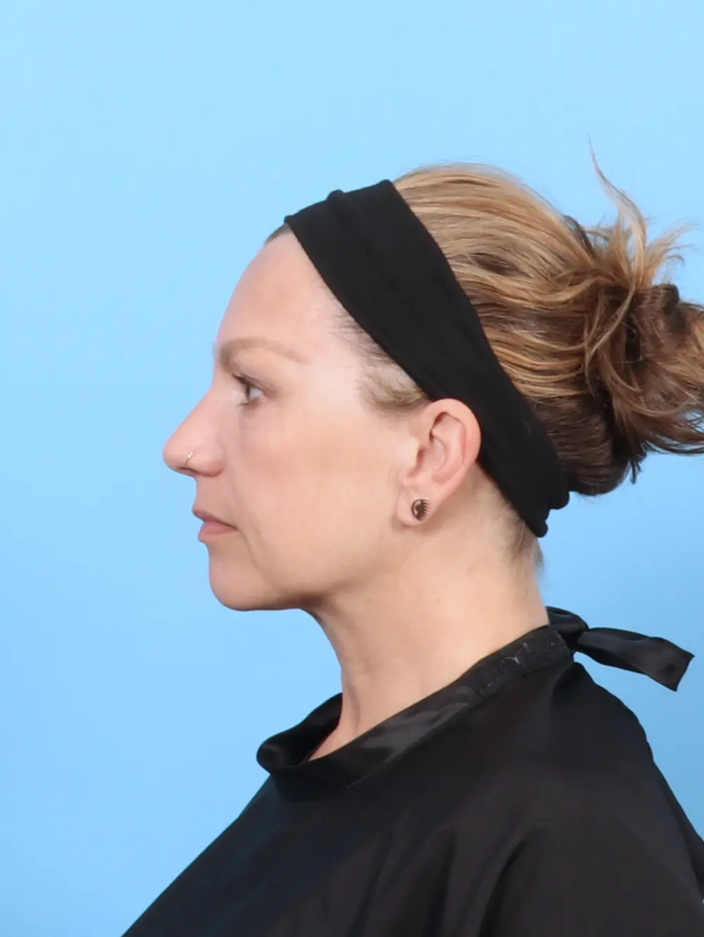 Eyelid Surgery Patient Photo - Case 55971 - before view-2