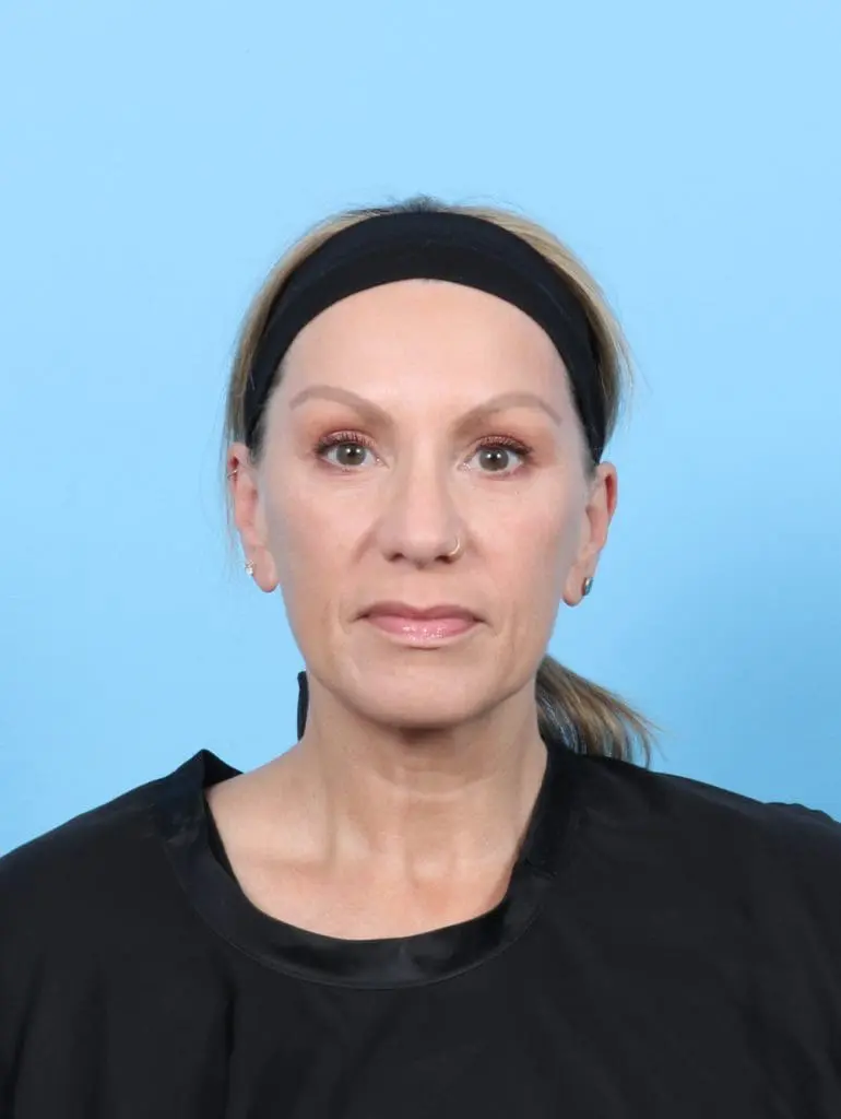 Eyelid Surgery - Case 55971 - After