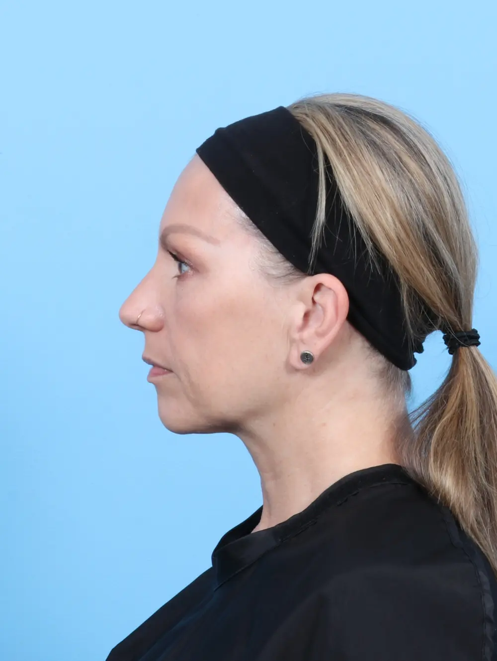 Eyelid Surgery Patient Photo - Case 55971 - after view-2