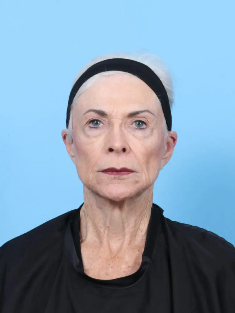 Laser Resurfacing - Case 55996 - Before