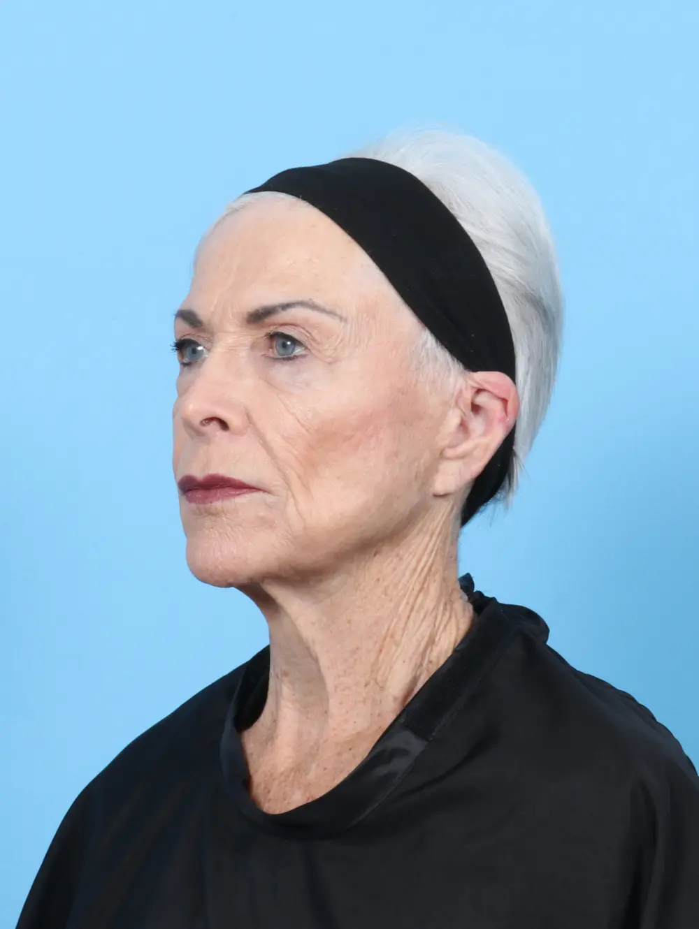 Laser Resurfacing Patient Photo - Case 55996 - before view-1