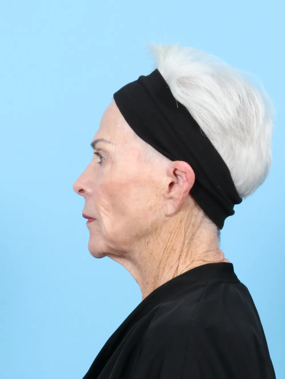 Laser Resurfacing Patient Photo - Case 55996 - after view-2