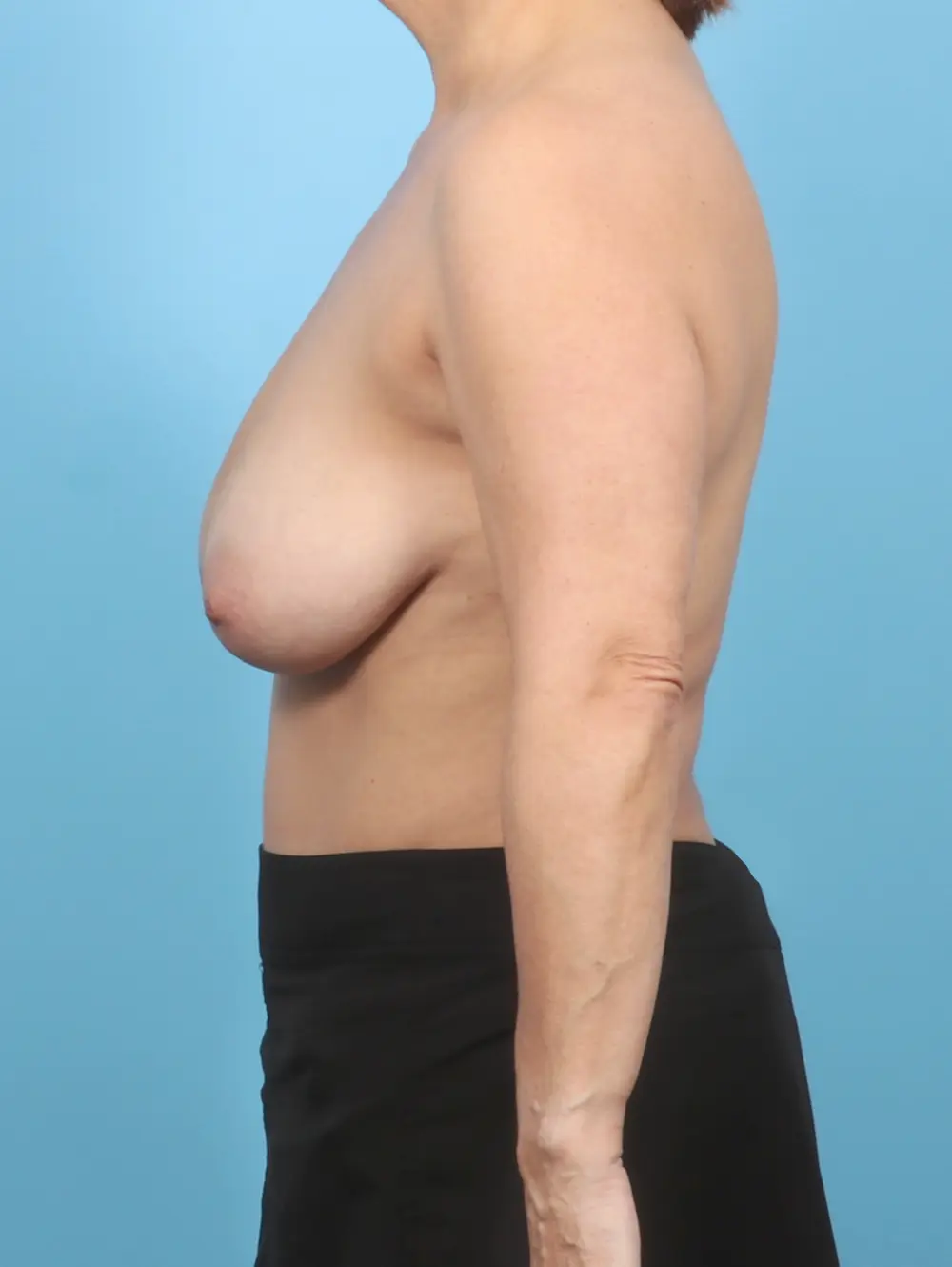 Breast Lift/Reduction w/o Implants Patient Photo - Case 56028 - before view-2