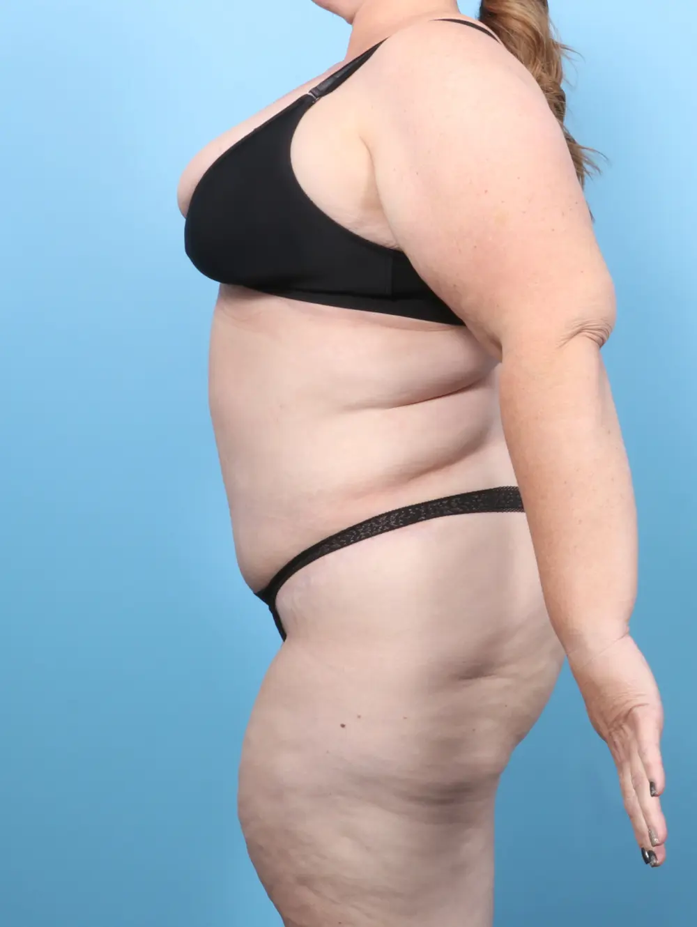 After Weight Loss Patient Photo - Case 56052 - after view-2