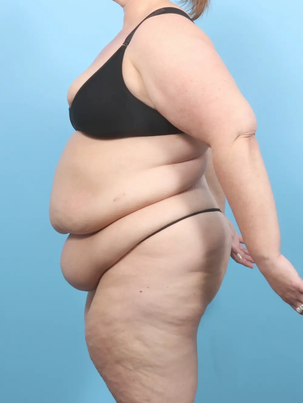 After Weight Loss Patient Photo - Case 56052 - before view-2