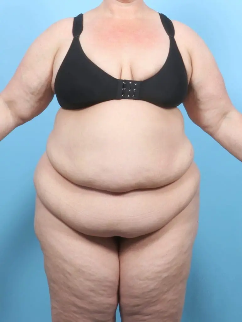 After Weight Loss - Case 56052 - Before