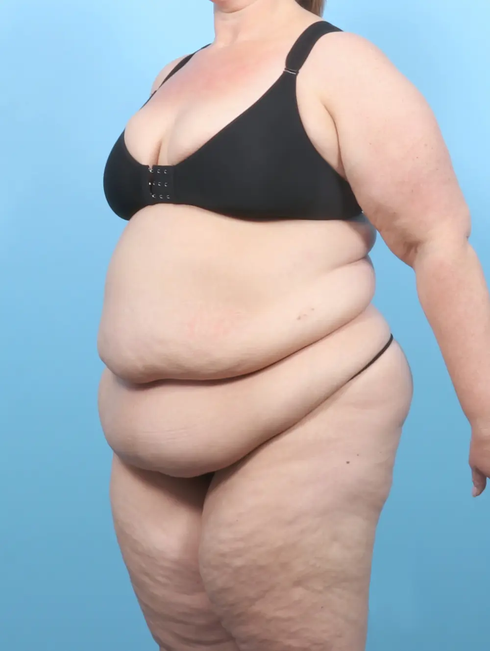 After Weight Loss Patient Photo - Case 56052 - before view-1